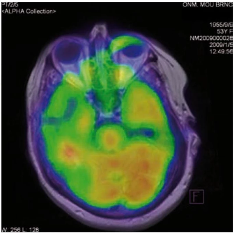 Pozitronová emisní tomografie mozku – solitární ložisko vyšší akumulace radiofarmaka temporálně vpravo, SUV<sub>max</sub> 12,53 (u pacientky 1).