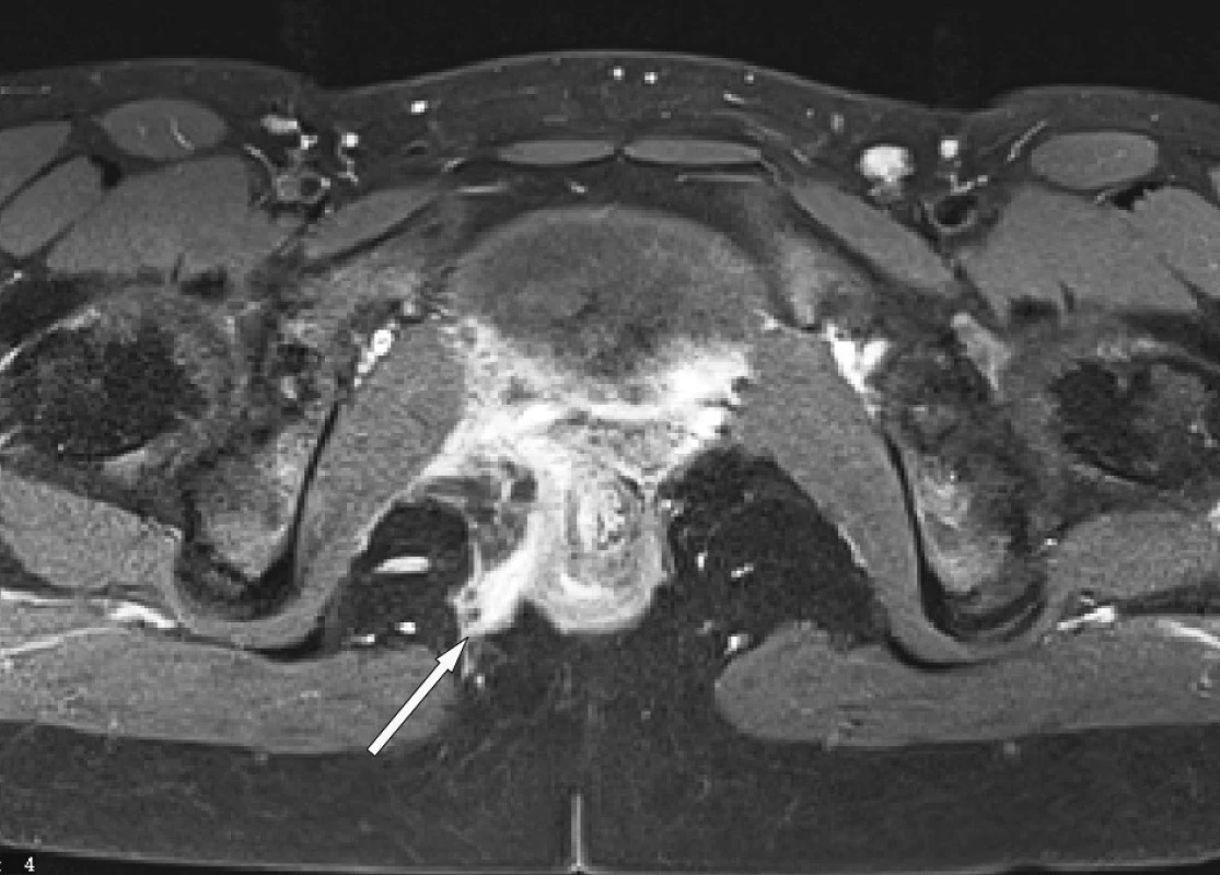 MR – transfinkterická a submukózní perianální píštěl vpravo
Fig. 5. MRI – transphincteric and submucous perianal fistula on the right
