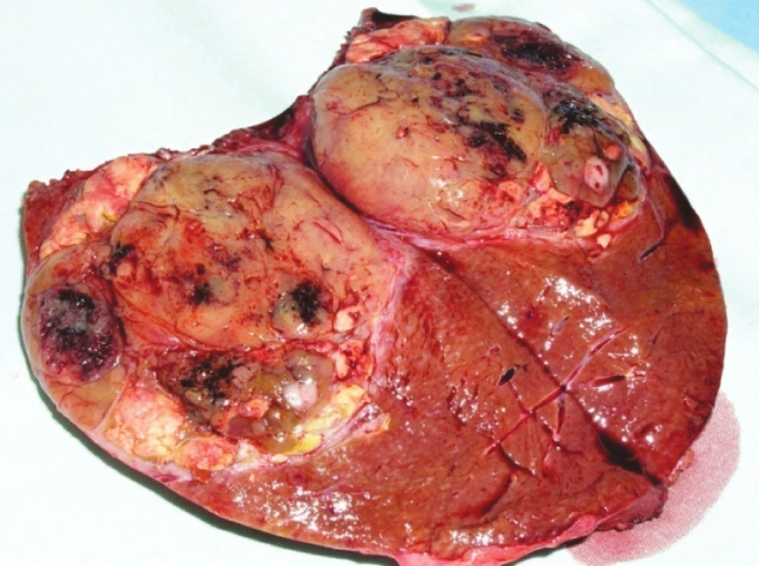 Metastáza renálního karcinomu v pravém laloku jater
Fig. 3. Renal carcinoma metastasis in the right liver lobe