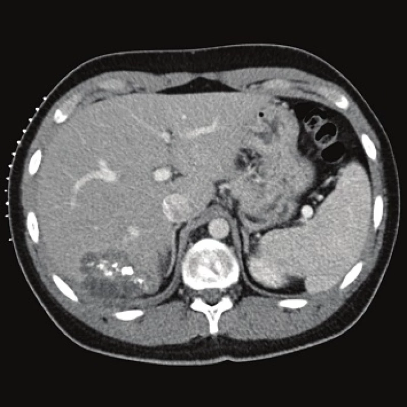 Contrast enhanced CT, venous phase, axial plane: the cystic component of the lesion and calcifications are clearly seen.