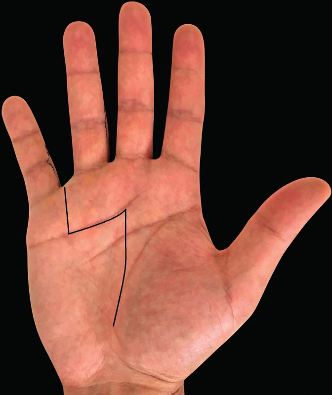 Incisions according to Meyerding