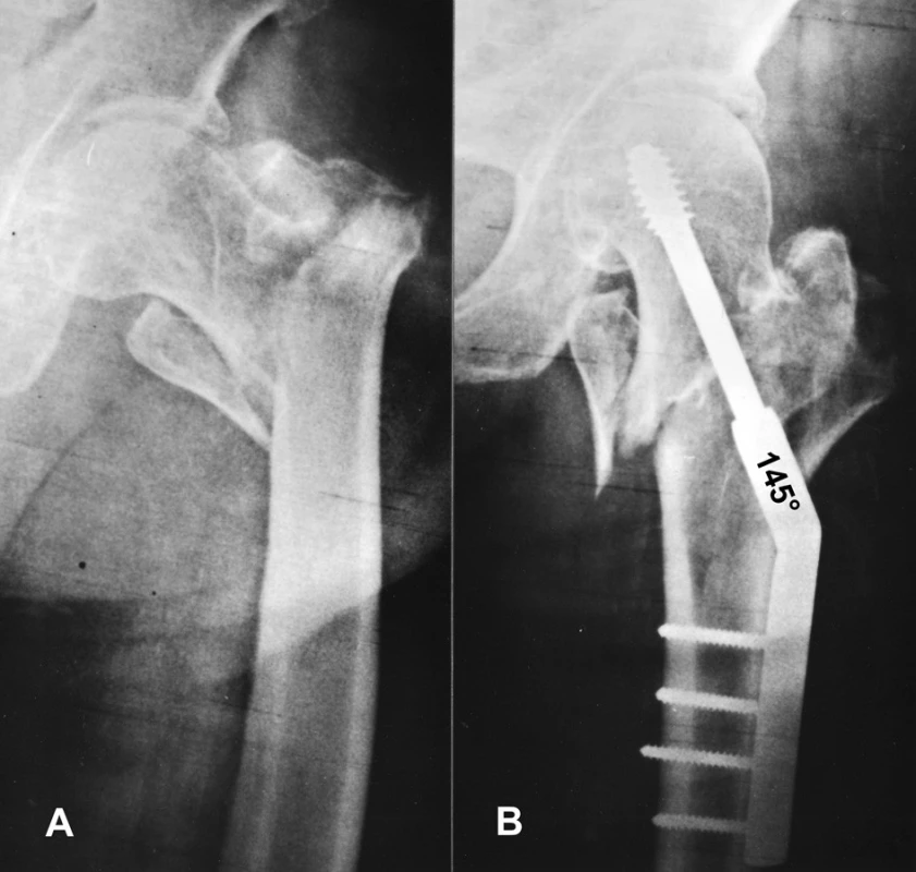 Valgizace nestabilní pertrochanterické zlomeniny a fixace DHS 145° Po valgizaci a fixaci valgózním implantátem směřuje při kompresi fragmentů krček femuru proti diafýze, nikoli proti velkému trochanteru.
Fig. 7: Valgus reduction of unstable pertrochanteric fracture and fixation by 145°DHS After valgus reduction and fixation by a valgus implant, the femoral neck is directed during compression of fragments toward the shaft and not toward the greater trochanter.