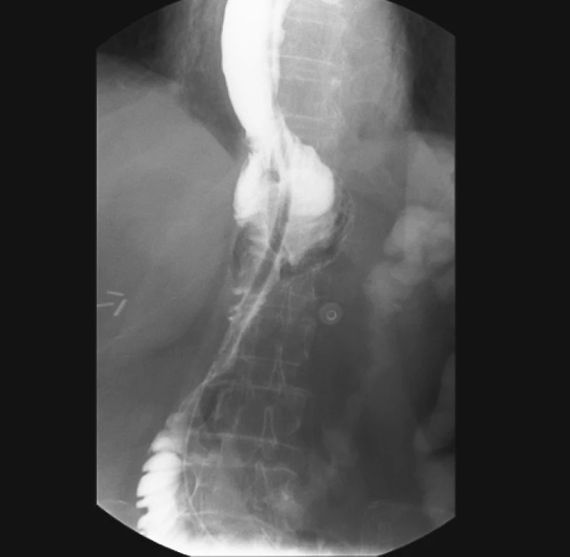 Kontrolní pasáž s rezervoárem sedmý den po operačním výkonu
Fig. 4. Control passage through the reservoir, postoperative day 7