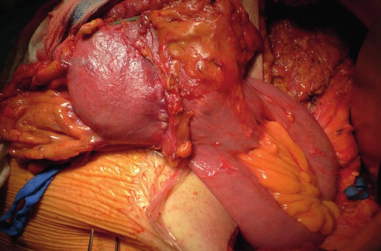 Pahýlový karcinom v oblasti anastomózy 42 let po BII resekci pro benignitu
Fig. 1: Gastric stump cancer 42 years after BII resection for benign disease, located at the anastomotic site