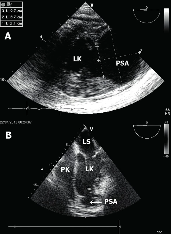 Pseudoaneurysma levé komory