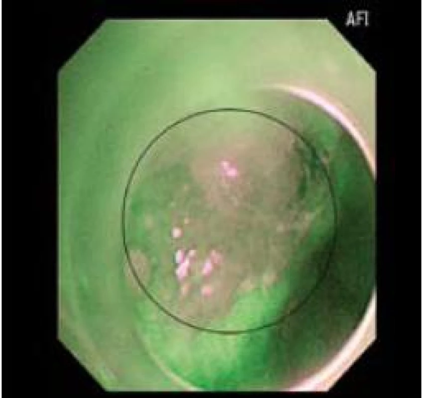 Stejné zobrazení časného adenokarcinomu jako obr. 1 a 2 v AFI.
Fig. 3. Imaging of early adenocarcinoma as in Figs. 1 and 2 in AFI.
