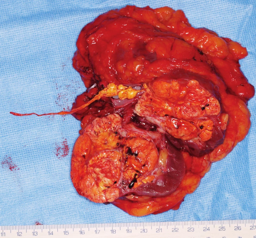 Žena 49 let s tumorem levé ledviny T3a s trombem v renální žíle. 1A – MRI axiální řez, zeleně označen tumor, zelenou šipkou trombus. 1B–D– MRA (B – pohled zepředu, C – zezadu) zobrazuje jednu tepnu (A) a anomální žilní zásobení připomínající „duplexní ovarickou žílu“: do levostranné ledvinné žíly se z kaudální strany vlévá silná žíla (mediální véna – MV), která je rudimentární levostrannou dolní dutou žilou, do ní ústí levostranná ovarická žíla (laterální žíla – LV), a také levostranné lumbální žíly. Rudimentární DDŽ je spojena s v. iliaca communis sin. – tato žíla se však vlévá hlavním tokem do pravostranné normální DDŽ. Při laparoskopii (1e) je dobře patrná „zdvojená ovarická žíla“ a i prosvítající trombus v renální žíle (označen šipkou). Po přerušení renální tepny těsně u aorty pomocí klipů (1F) je patrné, že žilní trombus je rozsáhlejší, byla provedena konverze v otevřený výkon a odstraněn dlouhý tenký trombus zasahující až do DDŽ (1G)
Fig. 1.  49-year-old woman with a tumour of the left kidney T3a with thrombus in the renal vein and anomaly of left ovaric vein. She underwent laparoscopic nephrectomy with open conversion due to advanced thrombus.