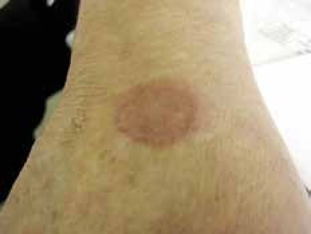 Granuloma anulare lokalizovaná forma