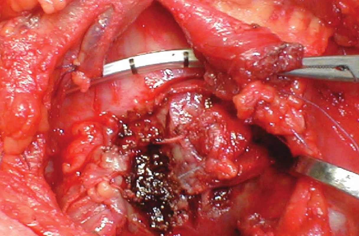 Obr. 3: Paliativní resekce istmu štítné žlázy
Fig. 3: Paliative resection of the thyroid isthmus

