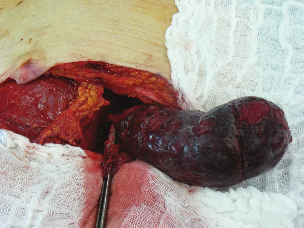 Peroperační nález invaginovaného úseku colon sigmoidei
Fig. 4: Intraoperative finding of the invaginated portion in the sigmoid colon area