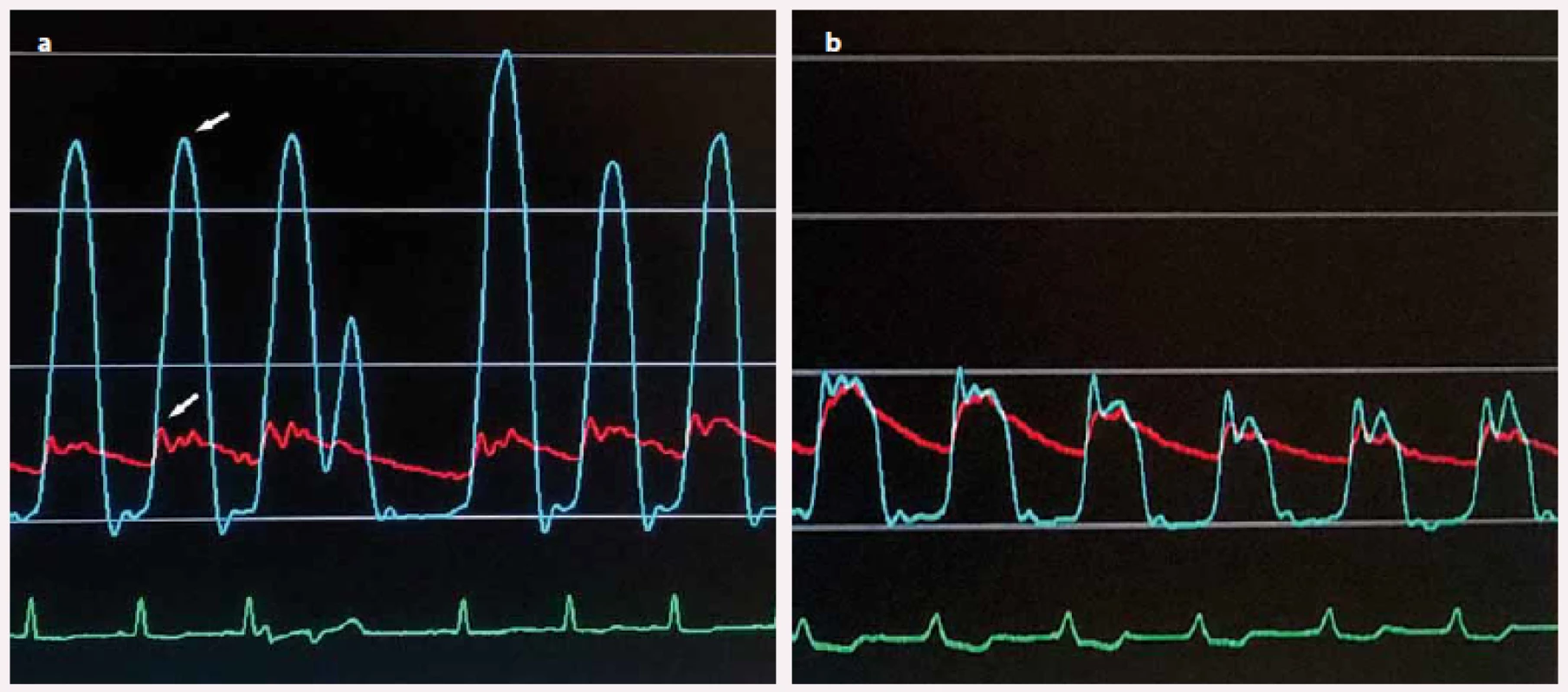 a) Invazivně měřený gradient ve výtokovém traktu levé komory (rozdíl tlakových křivek v hrotu levé komory (horní šipka) a výtokovém traktu (dolní šipka) před septální ablací; b) vymizení gradientu po septální ablaci.