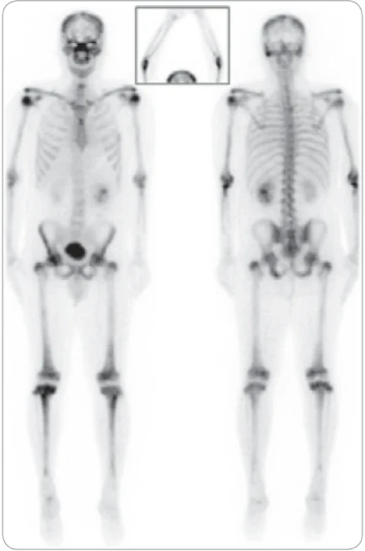 Vyšetření pacienta scintigrafií skeletu před zahájením léčby kladribinem.