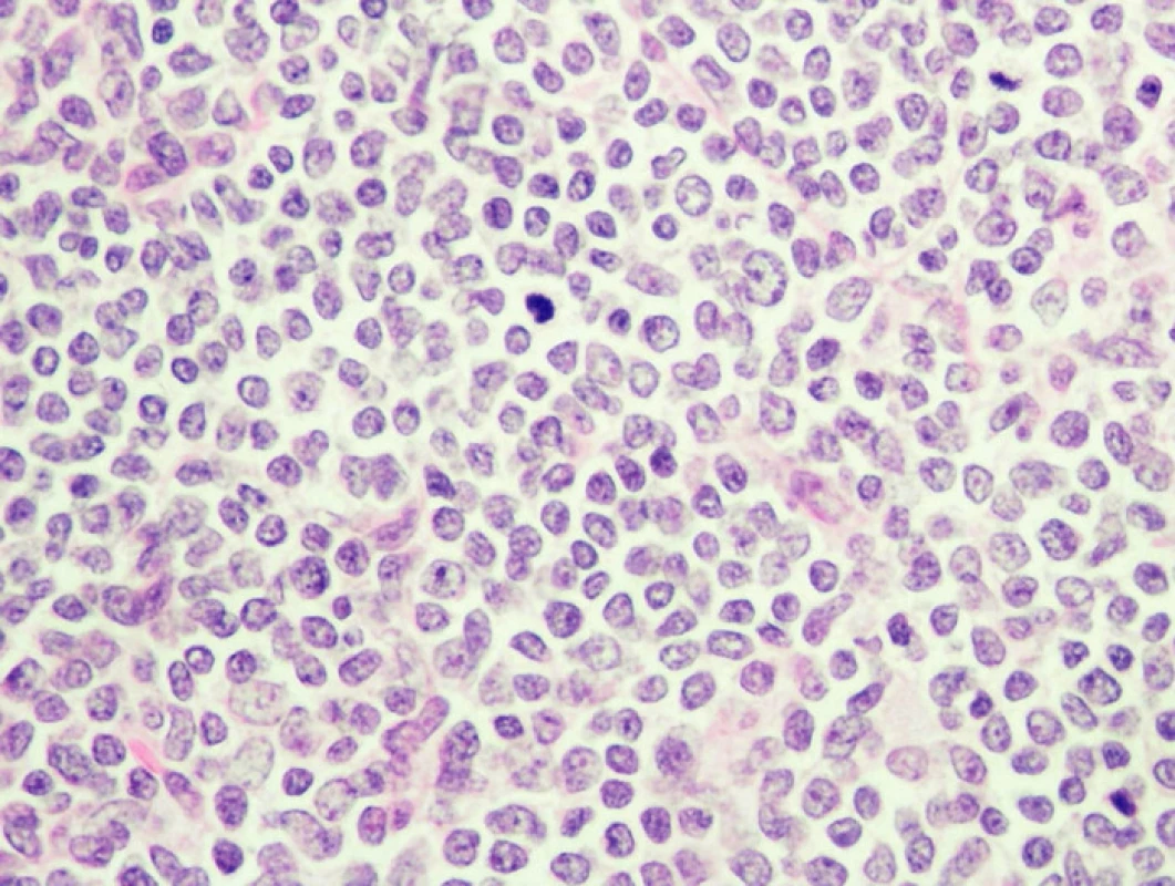 Histologický nález lymfomu z plášťových buněk v resekátu. (Prezentováno z materiálu ÚPAMB UK 2. LF a FNM Motol, Praha, přednosta prof. MUDr. R. Kodet, CSc.)
Fig. 7. Histopathological finding of mantle cell lymphoma. (Investigation at ÚPAMB UK 2. LF et FNM Motol, Praha; with courtesy of prof. R. Kodet, MD, PhD)