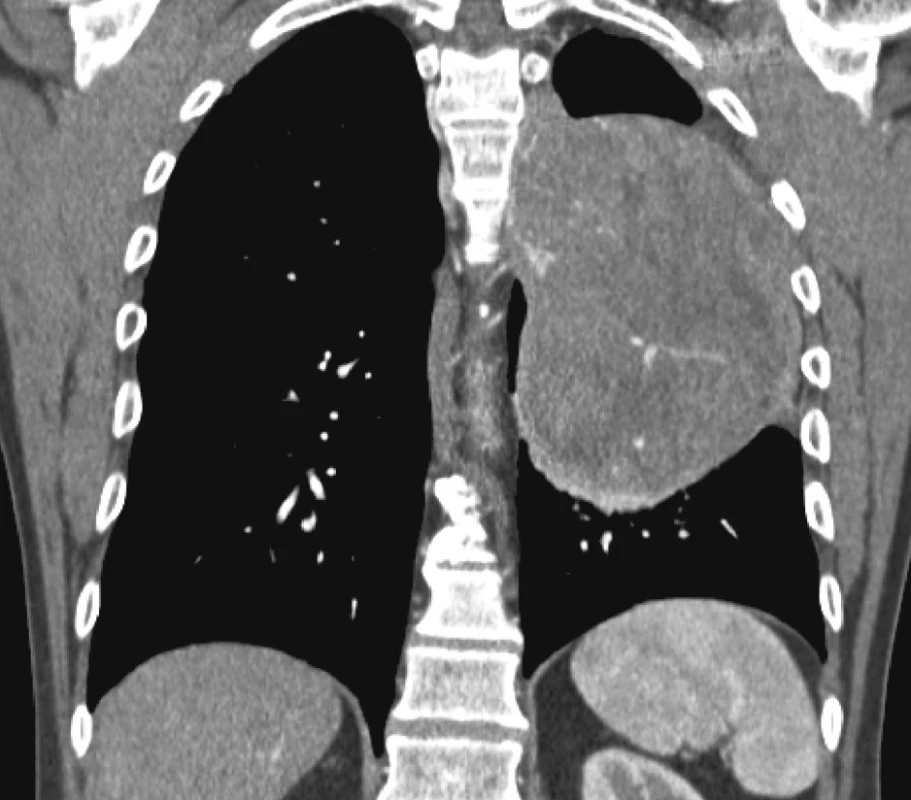 Infiltrativně rostoucí SFT
Fig. 2. Infiltrative SFT