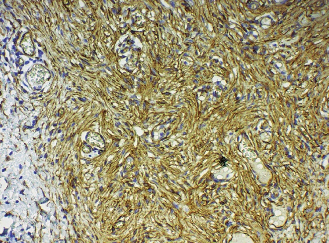 Pozitivita CD 34 ve vřetenitých fibroblastech, kongenitální část, 200krát