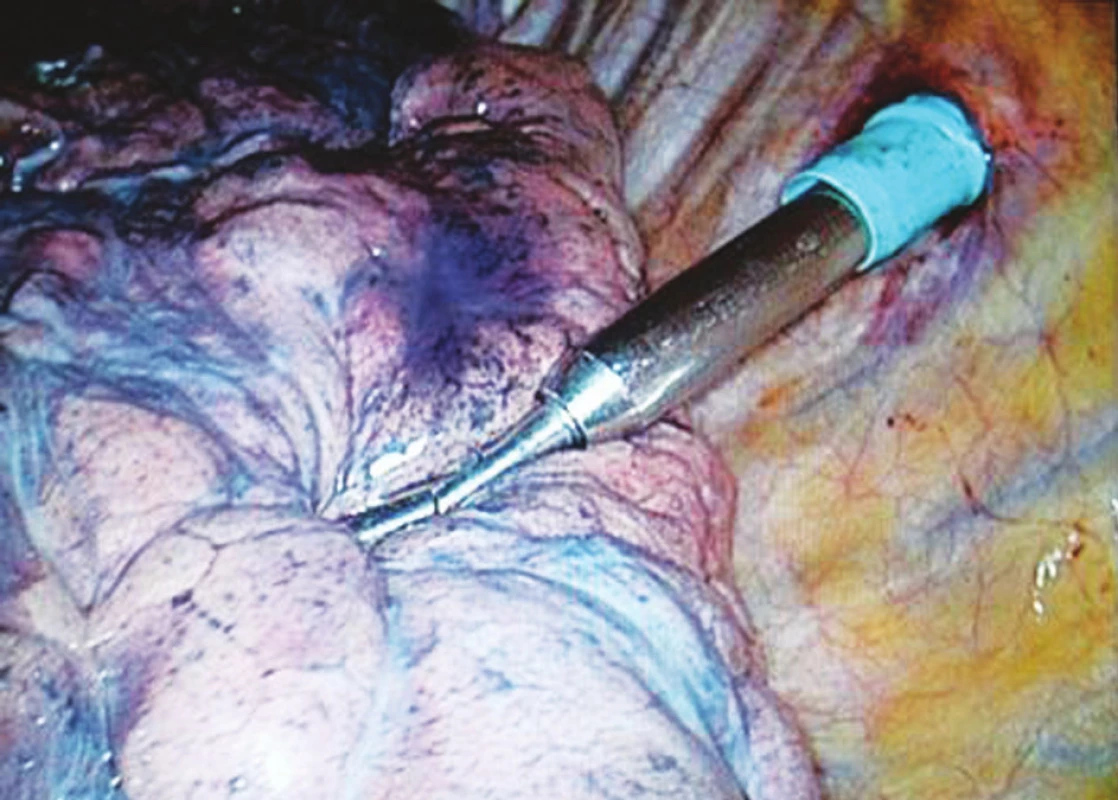 Barevné značení nehmatné plicní léze v S6 dolní lalok vlevo
Pic. 2. Dye marking of non-palpable pulmonary lesion in S6 of the left inferior lobe