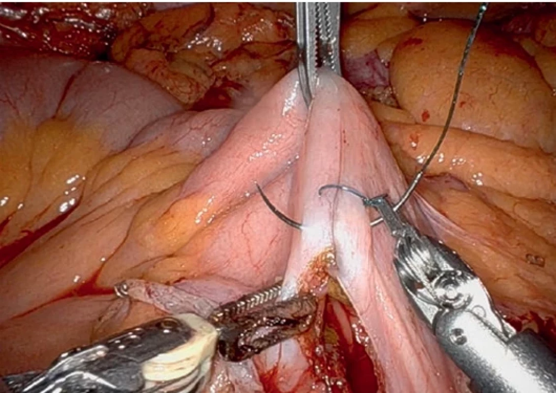 Uzávěr defektu po staplerové anastomóze.  Post anastomosis defect closing.