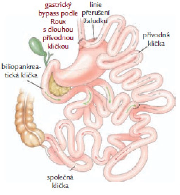 Hybridní, „kombinovaný“ výkon – gastrický bypass podle Roux.