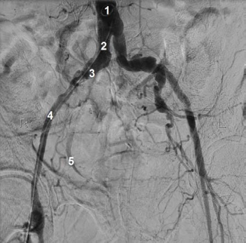 Angiografie břišní aorty a pánevních tepen. 1) Břišní aorta, 2) společná ilická tepna vpravo, 3) odstup vnitřní ilické tepny (vpravo), 4) zevní ilická tepna vpravo, 5) pravý močovod (s kontrastní látkou)
Fig. 2 Angiography of the abdominal aorta and pelvic arteries. 1) Abdominal aorta, 2) right common iliac artery, 3) distance of internal iliac artery (right), 4) external iliac artery, 5) right ureter (with contrast agent)