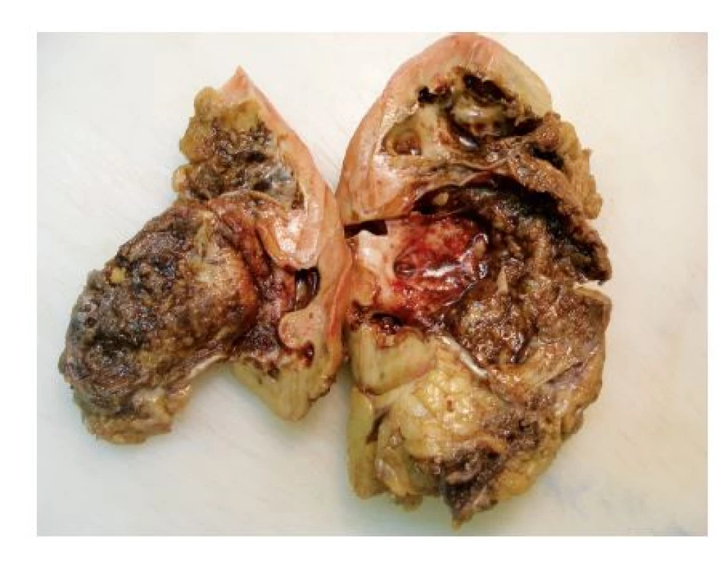 Průřez ledvinou s atrofickým parenchymem a nápadně dilatovanou pánvičkou přecházející ve ztluštělý ureter
Fig. 4. The cross-section of the left kidney with atrophic parenchyma and transition from hydronephrotic pelvis in the hypertrofic ureter