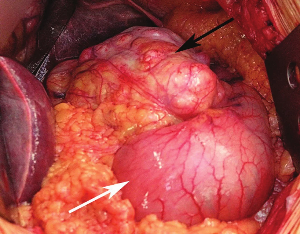 Rozsáhlý gastrointestinální tumor postihující malou křivinu žaludku (černá šipka), zbytek žaludku je bez makroskopicky patrných změn (bílá šipka)
Fig. 1: Bulky GIST affecting the lesser curvature of the stomach (black arrow) while the rest of the stomach shows no macroscopically detectable changes (white arrow) Foto: MUDr. Petr Lochman, Ph.D.