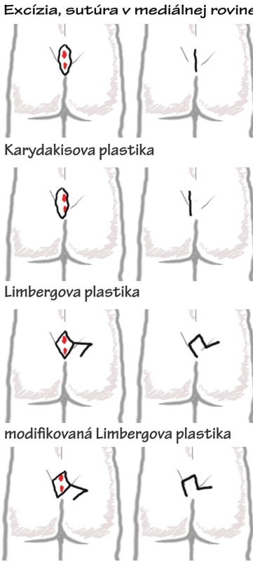 Názorný nákres jednotlivých chirurgických postupov pri liečbe sinus pilonidalis
Obr. 5. Scheme of surgical process of pilonidal sinus disease treatment
