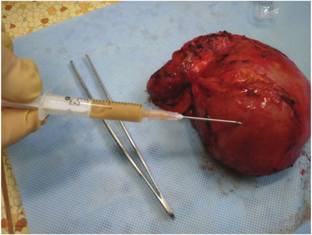 Punktát pseudocysty, obsah makroskopicky typický pro pseudocystu
Fig. 6. Pseudocyst punctate with fluid collection macroscopically typical for a pseudocyst