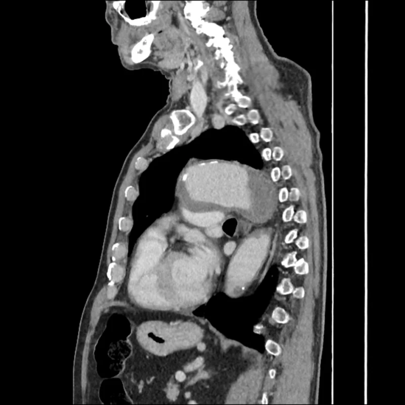 Aneurysma oblouku aorty – kontrastní CT vyšetření hrudníku, sagitální projekce