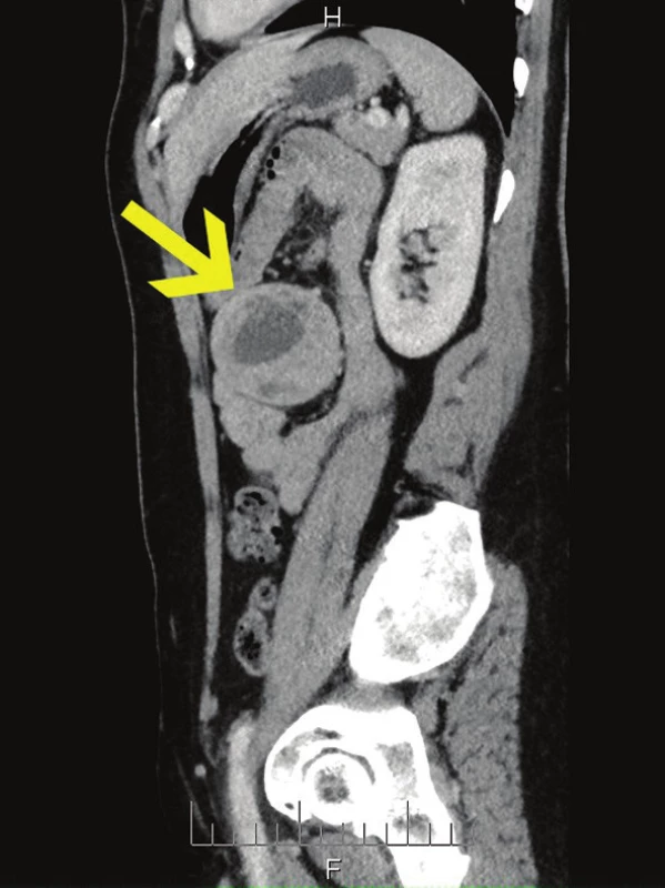 CT s tumorem v levém mezogastriu, sagitální řez
Fig. 2: CT scan with tumour in the left mesogastrium, sagittal section