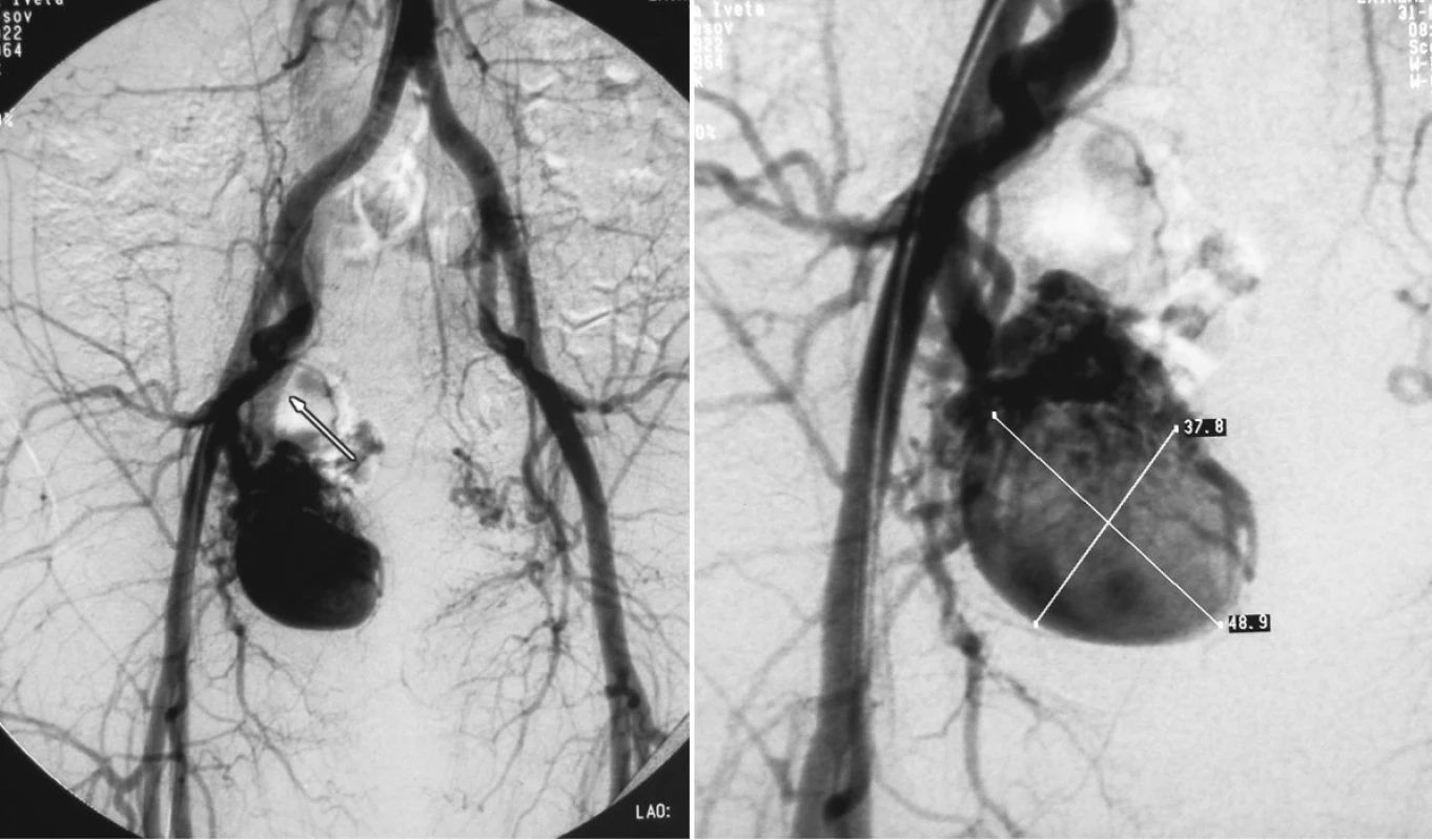 a, b. Pacient č. 2. DSA vyšetrením zobrazená aneuryzma arteria ilaca interna vpravo veľkosti 49x38mm
Pic. 4a, b. Patient Nr. 2: DSA examination revealing the internal iliac artery aneurysm on the right, measuring 49x38mm