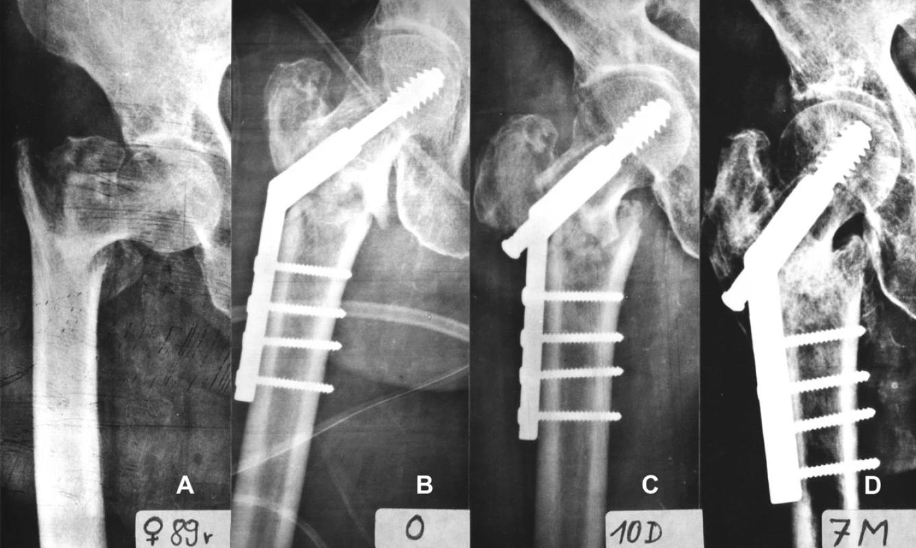 Medializace nestabilní pertrochanterické zlomeniny: a – nestabilní pertrochanterická zlomenina, zeslabení laterální trochanterické stěny; b – rtg snímek bezprostředně po operaci, osteosyntéza valgózně (140°) zreponované zlomeniny pomocí DHS 135°, při repozici nalomena laterální trochanterická stěna, mediální kortikalis obou hlavních fragmentů jsou v kontaktu; c – rtg snímek 10 dní po operaci, komprese obou hlavních fragmentů v ose skluzného šroubu, medializace diafýzy femuru, ztráta kontaktu mediálních kortikalis, zlomenina je potenciálně varózně nestabilní, ale pozice skluzného šroubu je optimální; d – rtg snímek 7 měsíců po operaci, zlomenina zhojena ve zkratu končetiny, nedošlo však k varizaci, medializace diafýzy progredovala pouze o několik mm. 
Fig. 13: Medial displacement of an unstable pertrochanteric fracture: a – an unstable pertrochanteric fracture, weakening of the lateral trochanteric wall; b – radiograph taken immediately after operation, internal fixation of the fracture after valgus reduction (140°) with DHS 135°, the lateral trochanteric wall slightly fractured during reduction, medial cortices of both main fragments are in contact; c – radiograph 10 days postoperatively, compression of both main fragments along the axis of the lag screw, medial displacement of the femoral shaft, loss of contact of medial cortices, the fracture is potentially unstable in varus position, but the position of the lag screw is optimal; d – radiograph 7 months postoperatively, the fracture healed with a limb shortening, however without varus displacement; medial displacement progressed only by several mm.