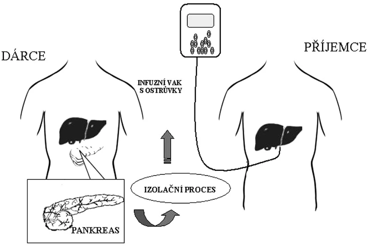 Schéma izolované transplantace Langerhansových ostrůvků aplikovaných z perkutánního transhepatálního přístupu do portálního řečiště jater
Fig. 1. Scheme of isolated transplantation of the islets of Langershans, implanted from percutaneous transhepatic approach into the portal bed