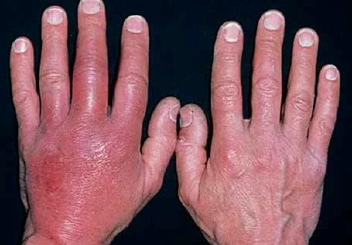 Celulitis – bakteriální kožní infekce.