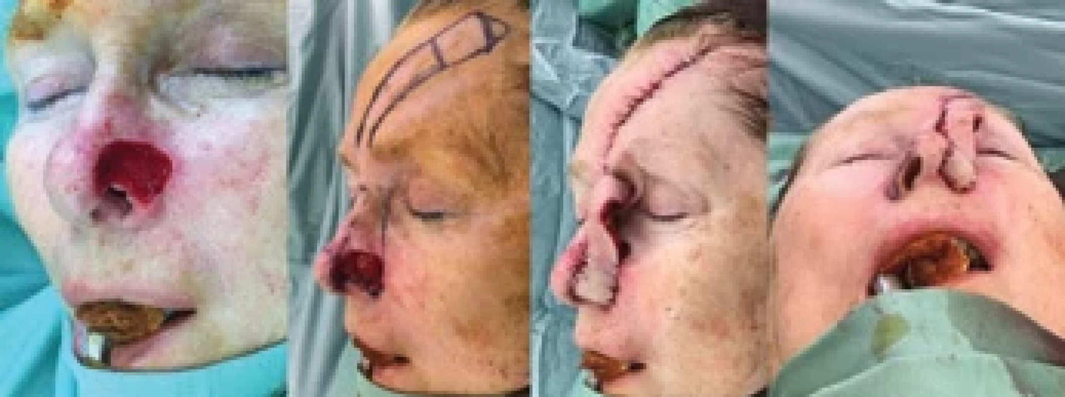First stage of nasal reconstruction with a duplicated forehead fl ap. (Source: author's photo archive).