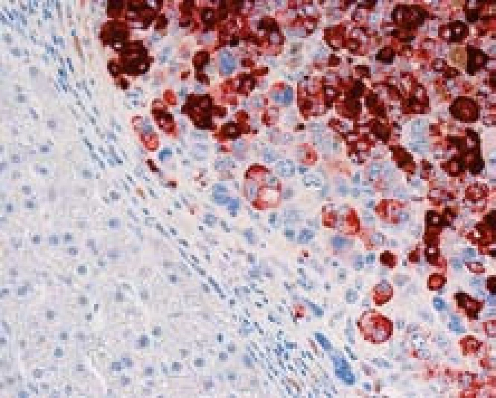 Imunohistochemický průkaz glypicanu-3. Na snímku je membránová i cytoplazmatická pozitivita v nádorových buňkách, úsek cirhotického uzlu vlevo je negativní, zvětšení objektiv 40×. 
Fig. 3. Positive glypican-3 immunostaining with membrane and cytoplasmatic positive detection in the HCC cells. Negative staining of cirrhotic nodule on the left side; high power field.