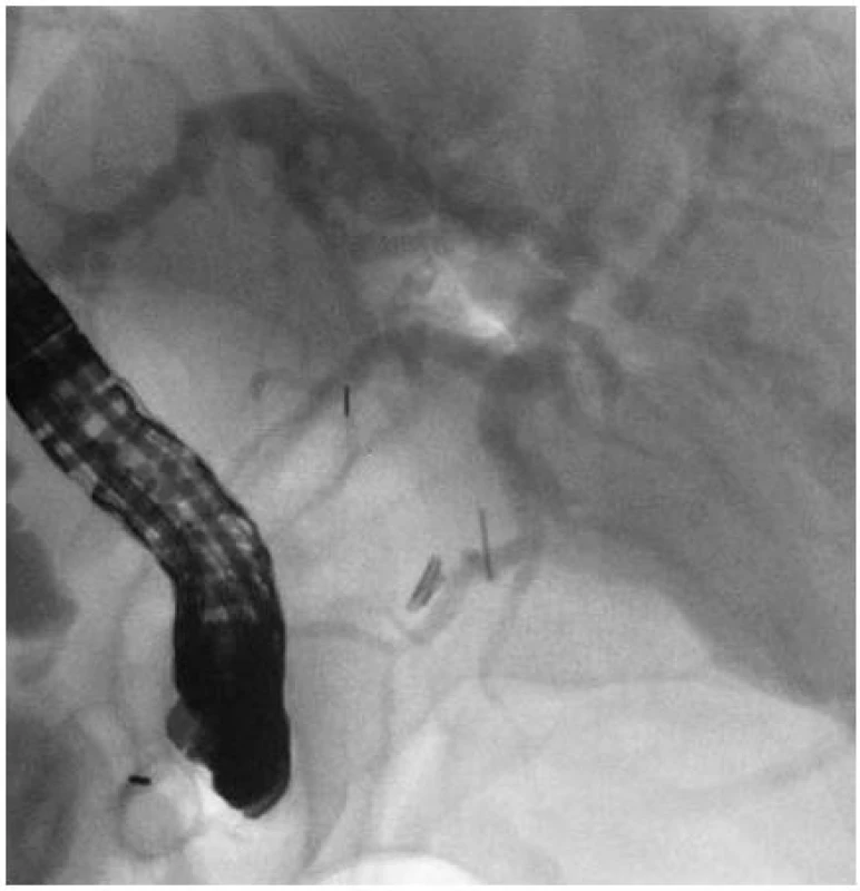 Stav po zavedení biodegradibilního stentu, na koncích stentu znatelné RTG kontrastní značky.
Fig. 2. Condition after installing a biodegradable stent, X-ray contrast medium marks visible at stent ends.
