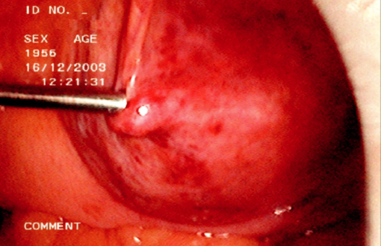 Peroperační laparoskopická aspirace obsahu lymfokély
Fig. 2. Intraoperative laparoscopic aspiration of the lymphocele contents