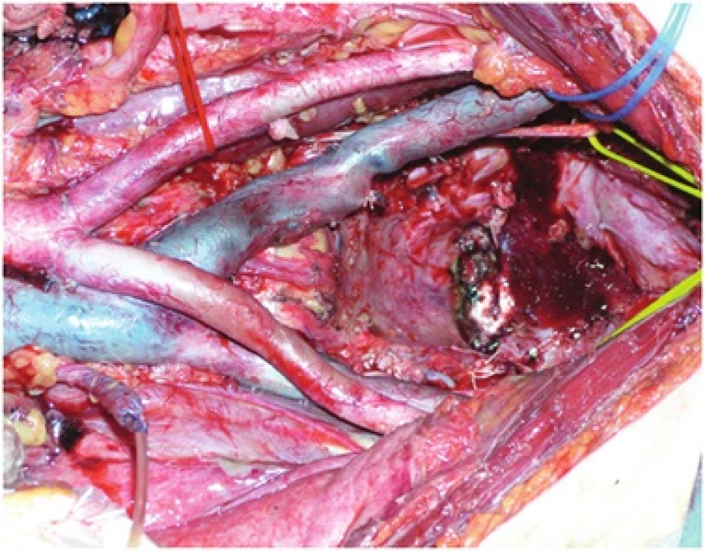 Stav po totální pelvické exenteraci
Fig. 1: Small pelvis after total pelvic exenteration