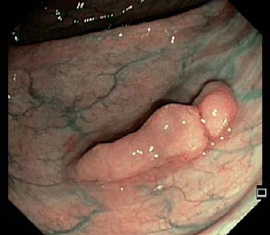 Přisedlý polyp transverza – zobrazení narrow band imaging (NBI).