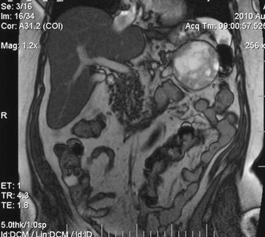 MRI vyšetrenie so zobrazeným tumorom vo frontálnej rovine
Fig. 6. MRI examination depicting the tumor, frontal view