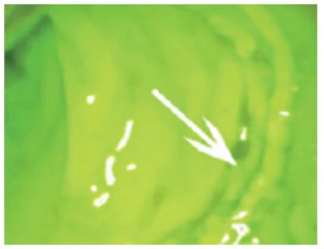 Transanální obraz kolorektální anastomózy (bílá šipka)
Fig. 3: Transanal image of colorectal anastomosis (white arrow)