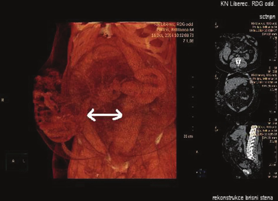 CT rekonstrukce svalů
Šipka – diastáza přímých svalů.
Fig. 3: CT muscles reconstruction
Arrow – diastasis mm. recti.