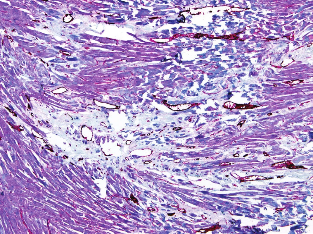 Dilatované venuly v hamartomu (Factor VIII – R Ag., Ventana, polyclonal, RTU, 100x).