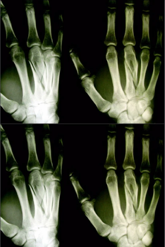 Zlomenina diafýzy typu B se spirálním interfragmentem (a) řešená dlahovou osteosyntézou (b)