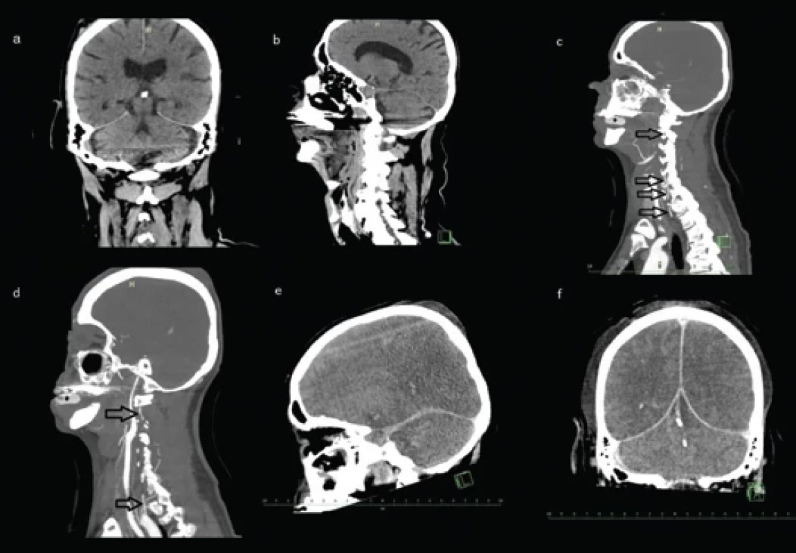 Initial brain CT scans taken upon the patient`s admission in the coronal (a) and sagittal planes (b) reveals early cerebral edema. (c) A sagittal CTA scan of the patient’s left side. This image demonstrates an absence of contrast fi lling during angiographic examination of the left vertebral artery. The light gray area represents a patent artery, with the arrow indicating dissection, and the darker gray color depicts artery collapse and no blood fl ow to the brain. (d) Sagittal CTA scans of the patient’s right side, depicting successive cuts of the course of the right vertebral artery. The darker gray color indicates a lack of contrast fi lling. (e, f) Control CT scan in the sagittal (e) and coronal planes (f) revealed transtentorial and occipital conus herniation and malignant cerebral edema.