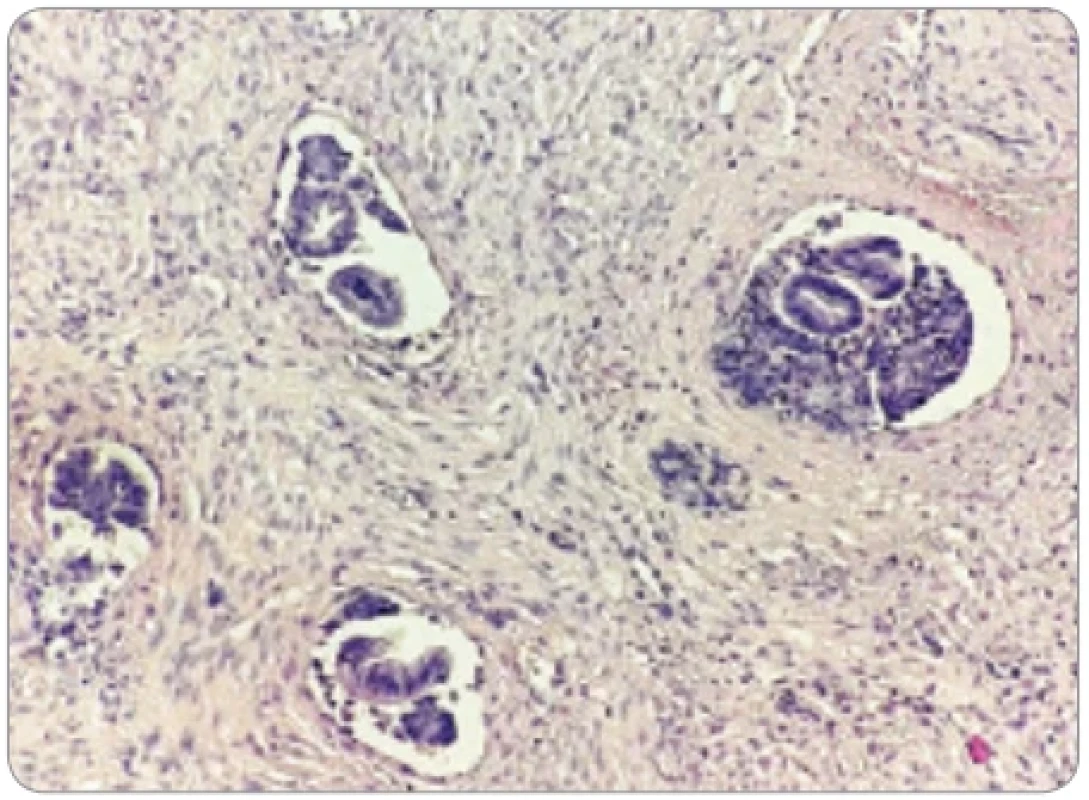 Agregáty endometriálneho tkaniva v krvných cievach myometria. (Farbenie hematoxylín & eozín, zväčšenie 200×).