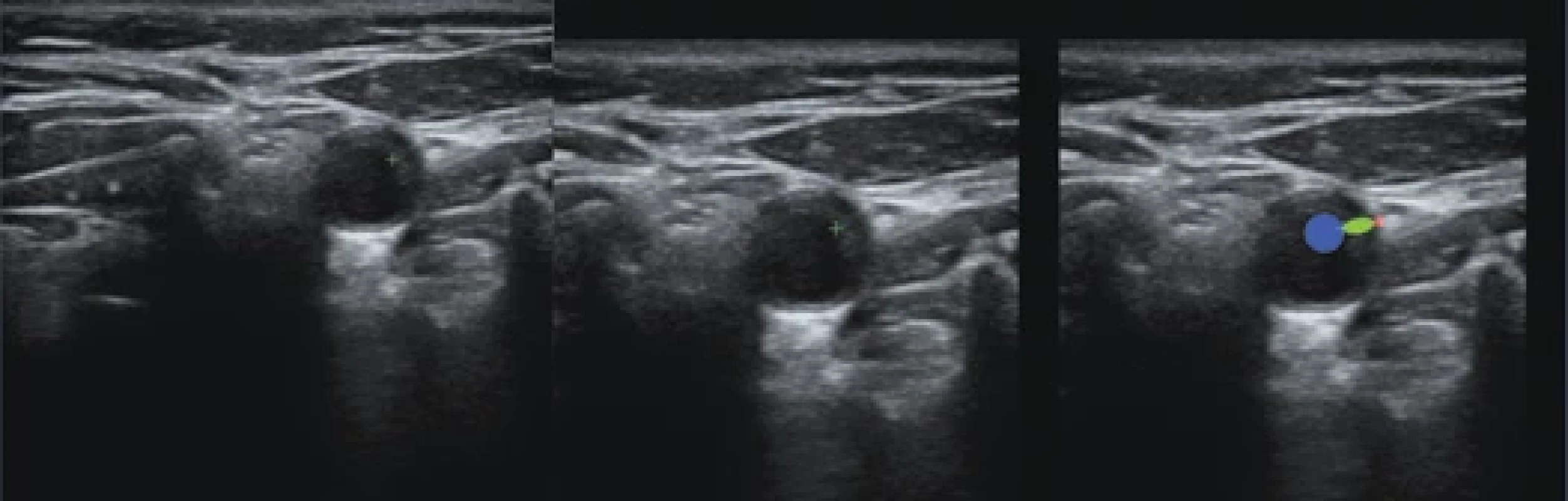 The original image (A) with the markers for plaque thickness measurement in green, its cropped version (B) and the automatically created incomplete weak segmentation (C).
