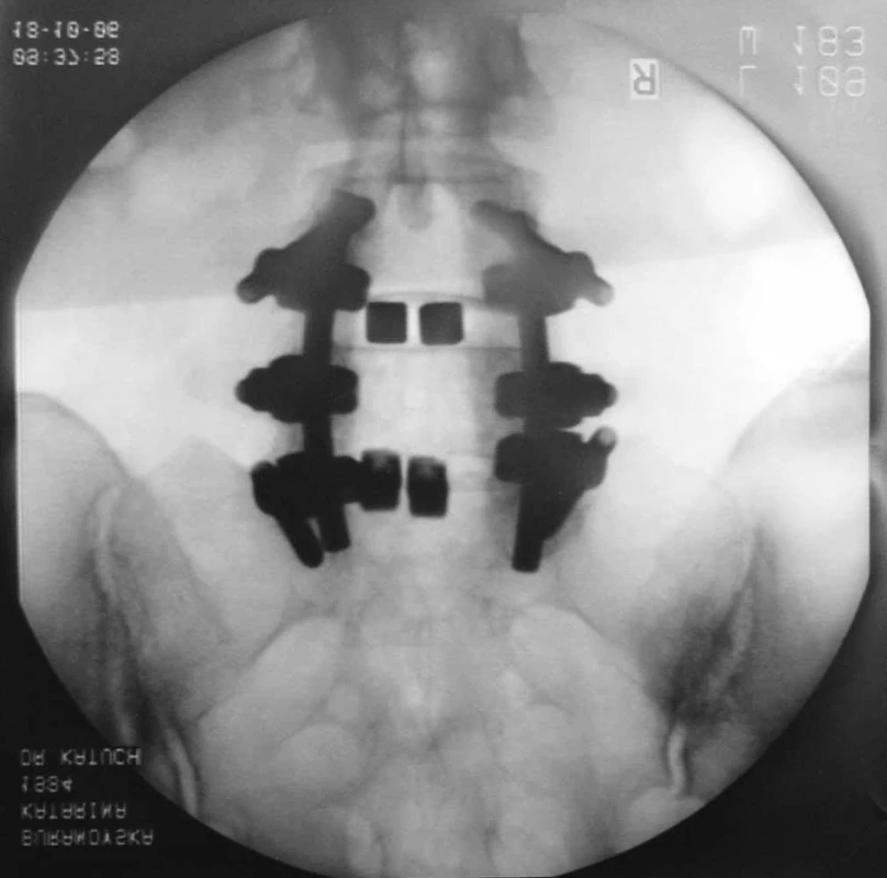 PLIF so zadnou transpedikulárnou stabilizáciou v dvoch úrovniach, L4/L5, L5/S1, 360° fúzia, predozadná projekcia (vlastný klinický materiál)
Fig. 4. PLIF with posterior transpedicular stabilisation in two levels L4/L5, L5/S1, 360° fusion, anterodorsal projection (authors’ outcomes)