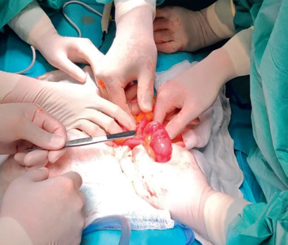 Perioperační nález. Finding during the surgery.