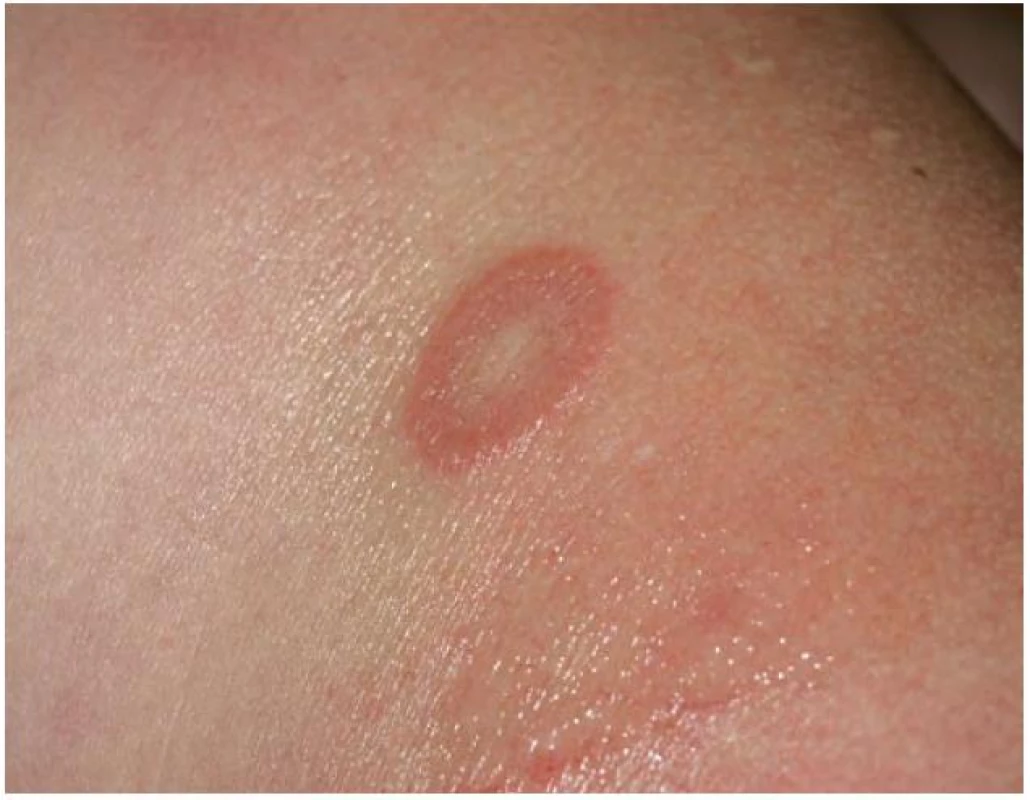 Granuloma anulare – anulárního ložisko